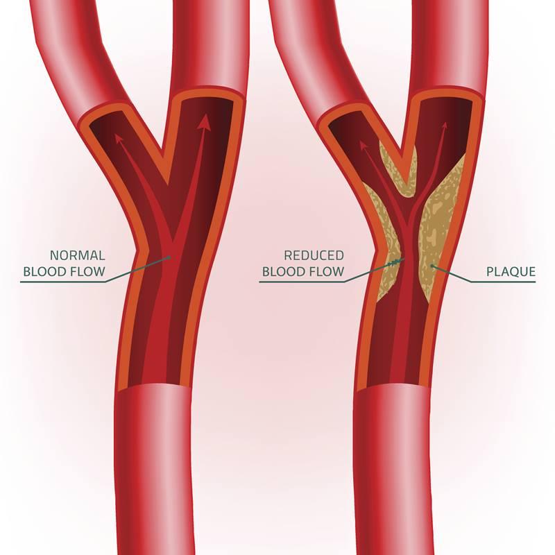 Dr. Peter Rentrop Discusses the Basics of Coronary Artery Disease (CAD)